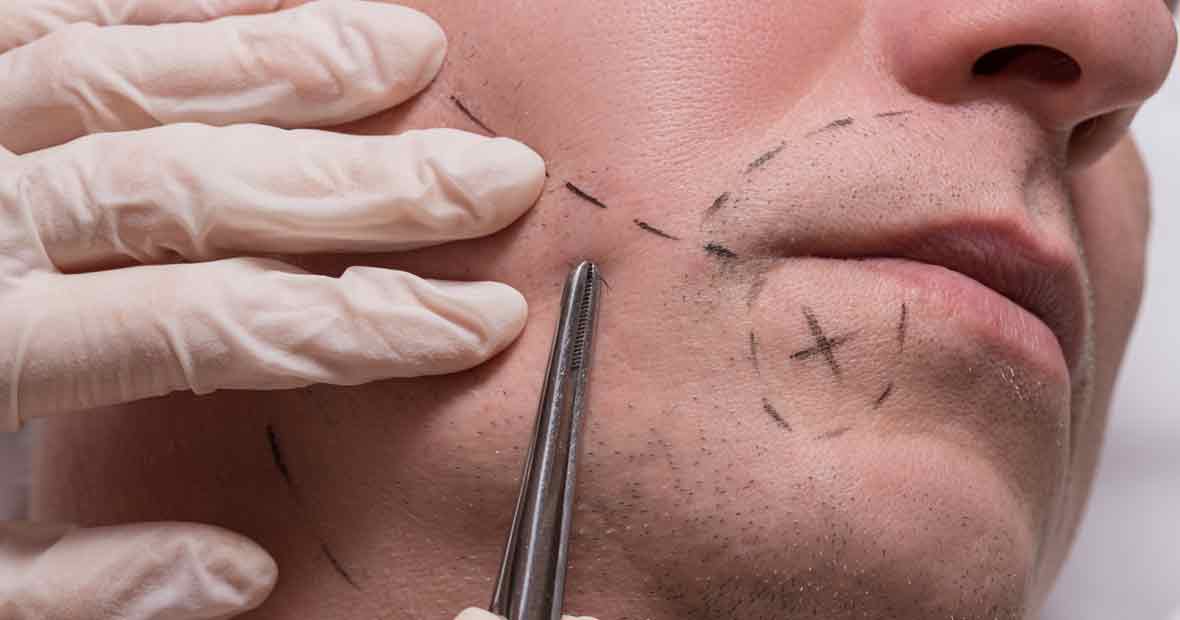 Beard Transplantation